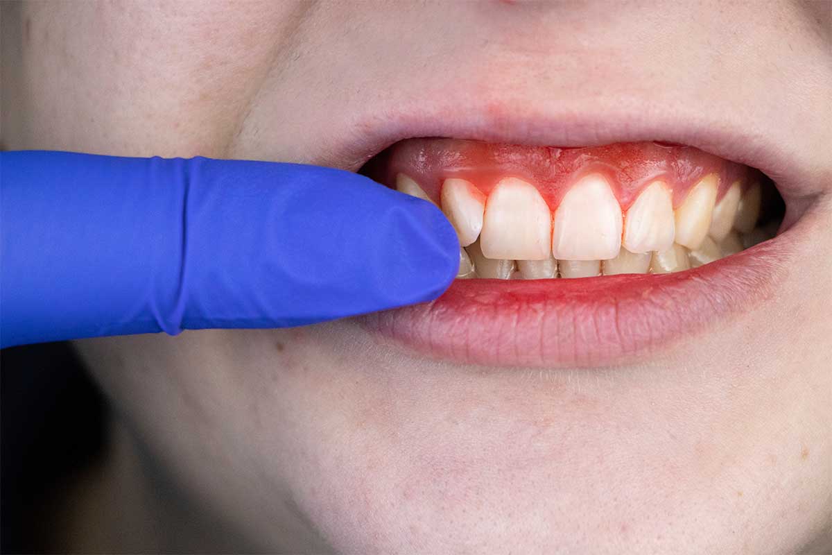 Tannkjøttbetennelse, også kjent som gingivitt