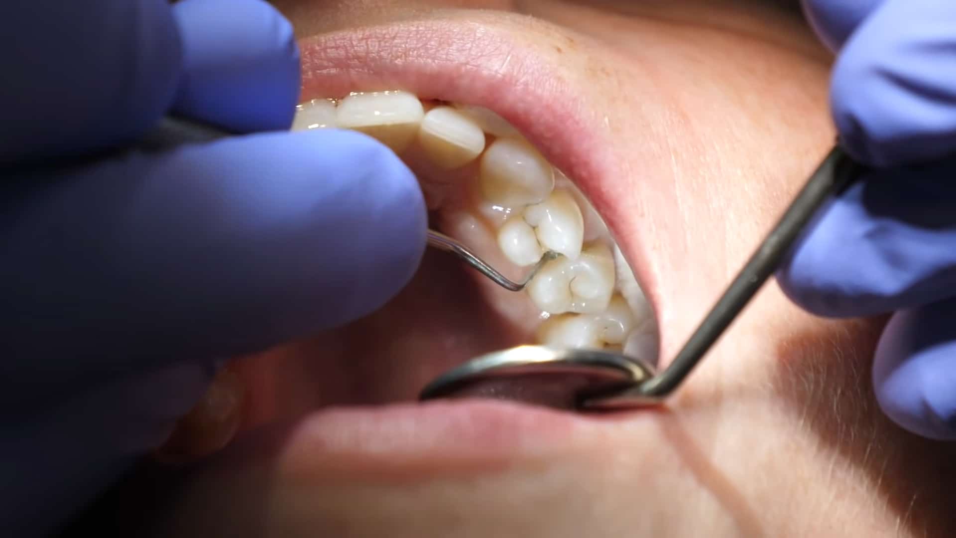 Tannlege renser tannoverflaten med dental instrumenter for å fjerne karies