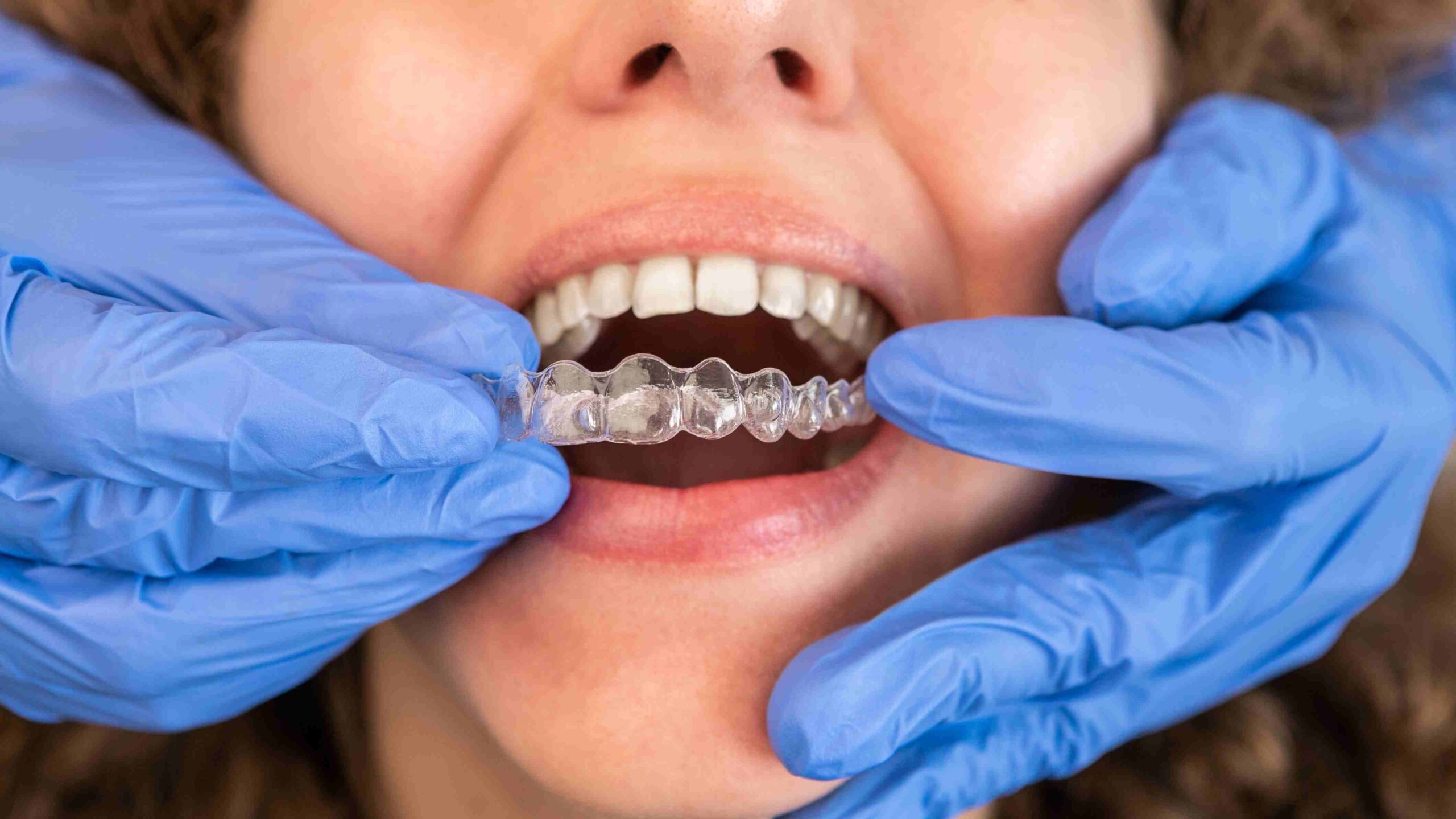 Tannlege med hansker hjelper pasient med å sette inn Invisalign-skinne