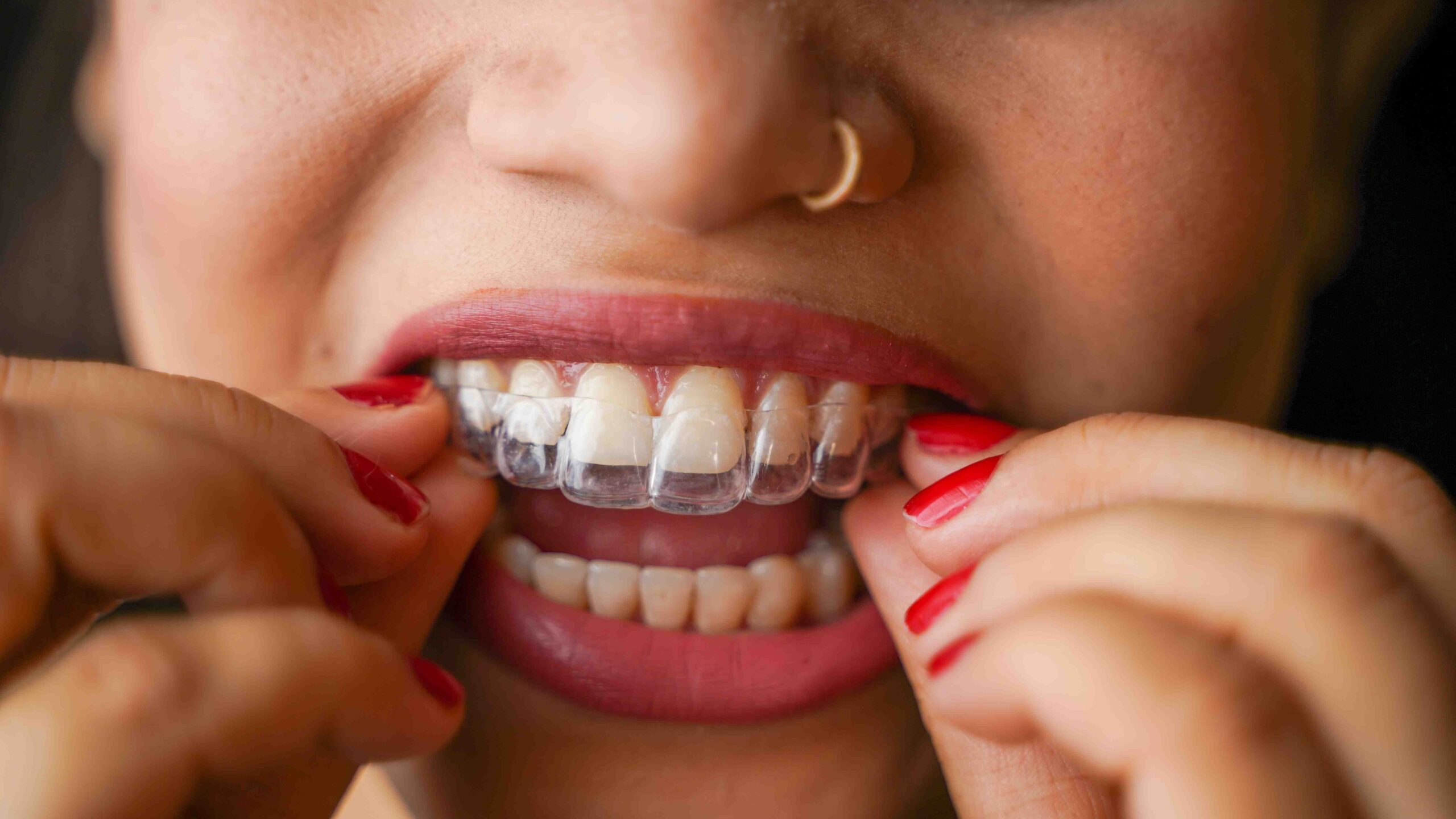 Kvinne som setter inn gjennomsiktig Invisalign-skinne foran tennene
